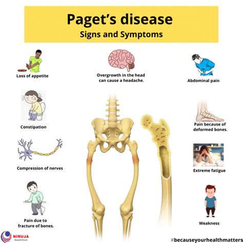 Overcoming the Pain and Suffering of Paget's Disease Of Bone Symptoms